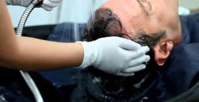 Précautions à prendre après une greffe de cheveux