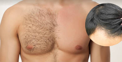 Body hair transplant to head