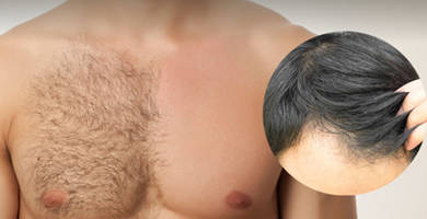 زراعة شعر الرأس باستخدام شعر الجسم