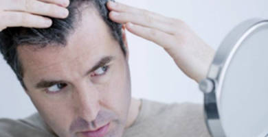 Caída del cabello después del trasplante capilar