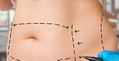 عملية شفط الدهون في تركيا