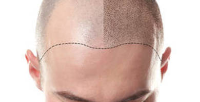 ¿Qué es la mesoterapia capilar, y qué resultados consigue?