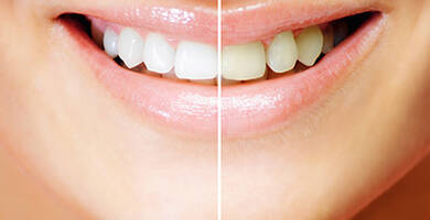 بعض المعلومات عن تبييض الأسنان