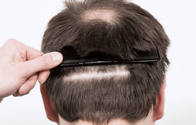 fue donor area