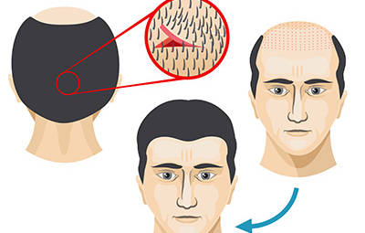 La Greffe de Cheveux FUT
