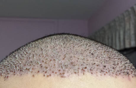 scabs after hair transplant