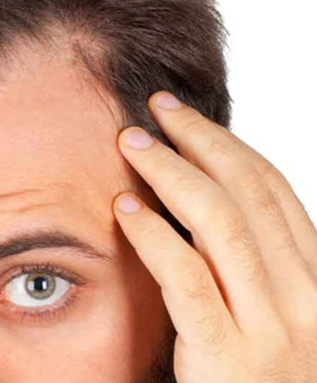 Preguntas y respuestas sobre el trasplante de pelo