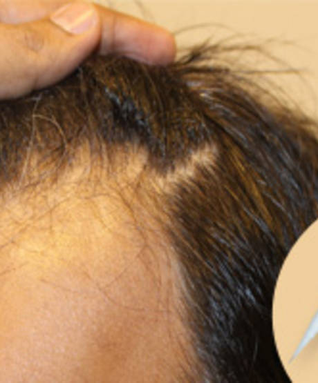 DHI przeszczep włosów