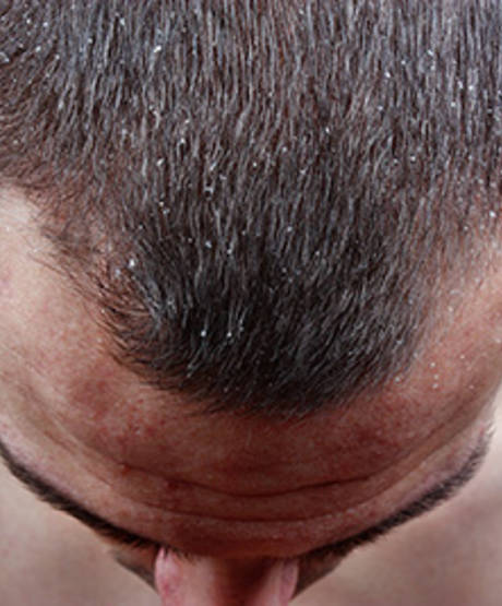 łupież wypadanie włosów