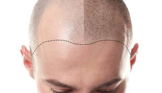 Mesotherapie gegen Haarausfall: Hilft sie beim Nachwachsen der Haare?