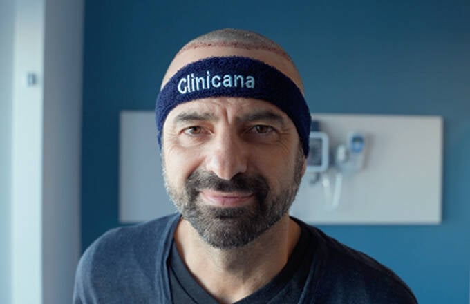 Top 10 Hair Transplant Clinics in Turkey