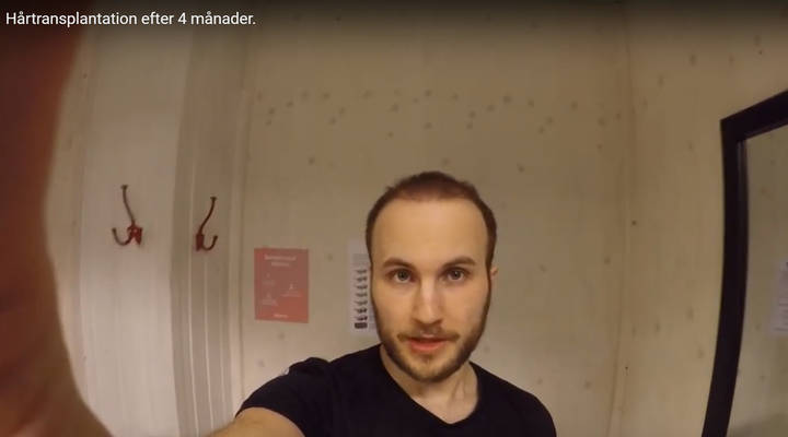 Jonas, Hårtransplantation efter 4 månader