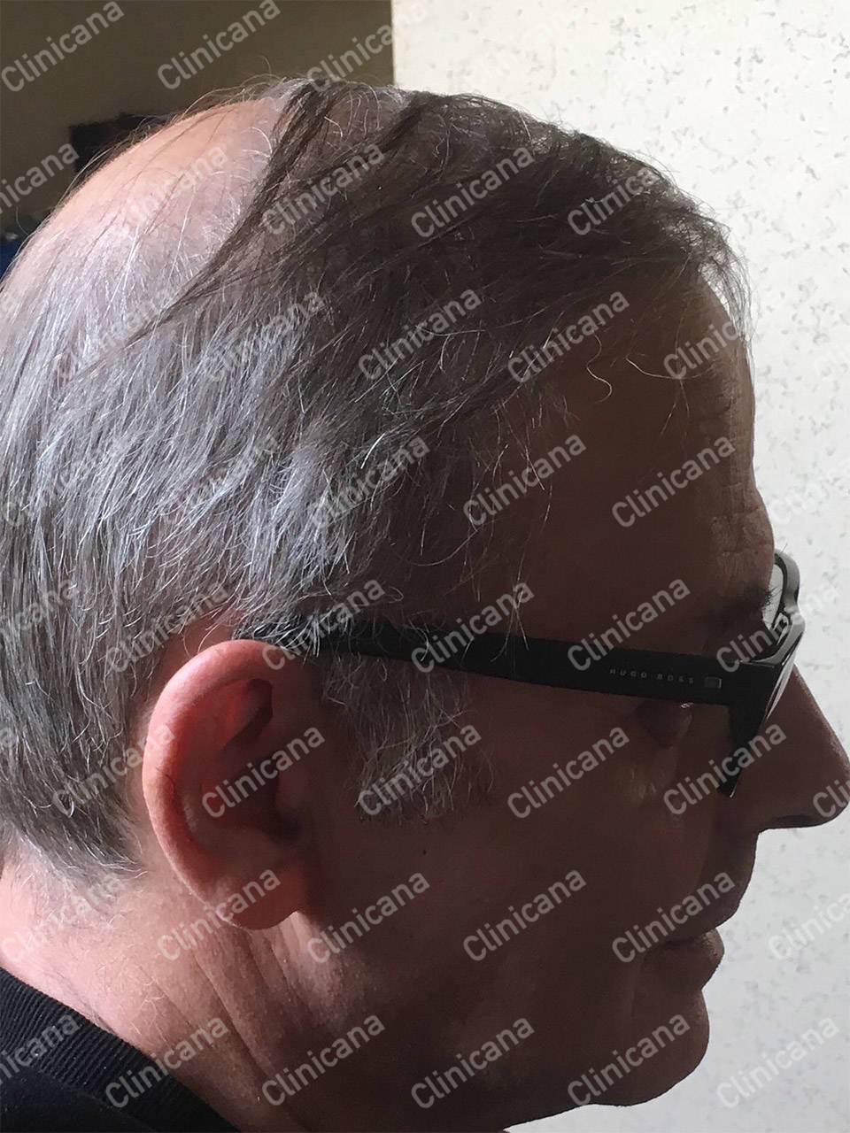 Hair Transplant Turkey FUE Hair Clinic Istanbul Clinicana