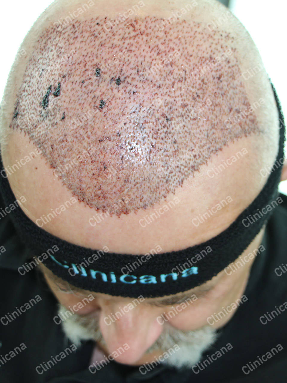 Greffe de Cheveux Turquie, Implant Capillaire Istanbul Clinicana