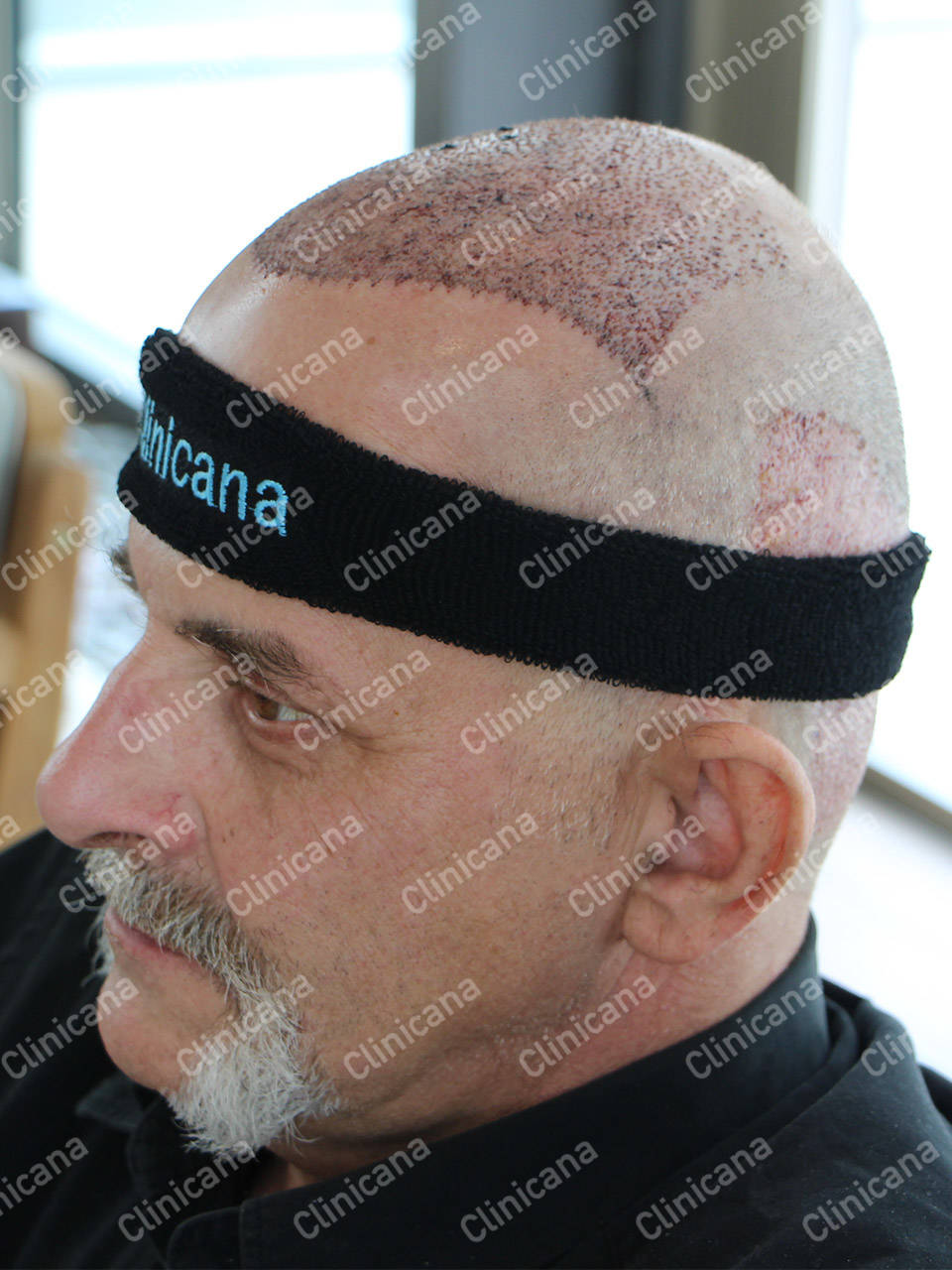 Greffe de Cheveux Turquie, Implant Capillaire Istanbul Clinicana