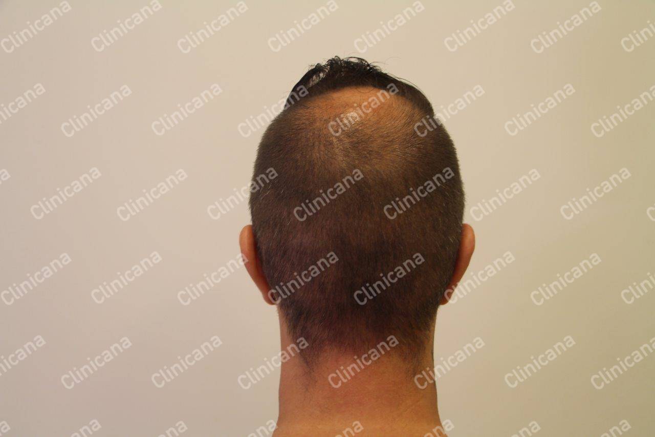Hair Transplant Turkey FUE Hair Clinic Istanbul Clinicana