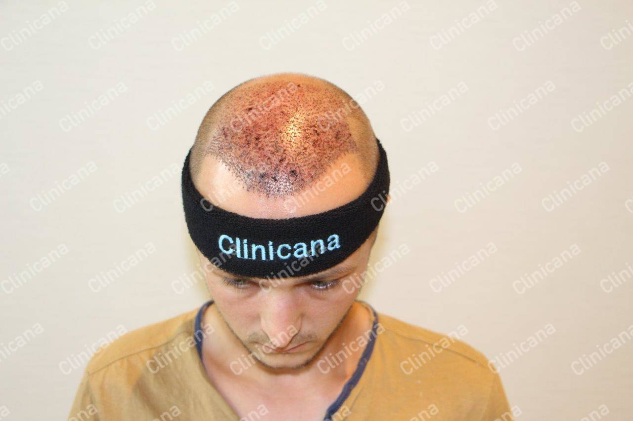 Hair Transplant Turkey FUE Hair Clinic Istanbul Clinicana