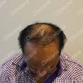 Before hair transplant