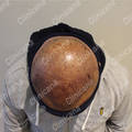 After hair transplant