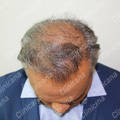 Result after hair transplant