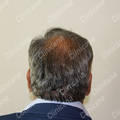 Result after hair transplant