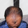 Before hair transplant