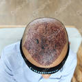 After hair transplant