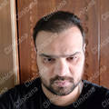 Result after hair transplant