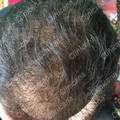 Result after hair transplant