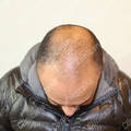 Before hair transplant