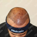 After hair transplant