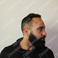 Result after hair transplant