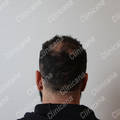 Result after hair transplant