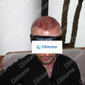 After hair transplant