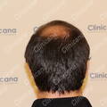 Before - Donor area