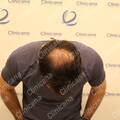 First hair transplant result