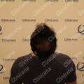 First hair transplant result