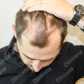 Before hair transplant