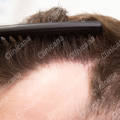 Result after hair transplant