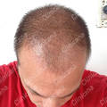 After 1 month hair transplant