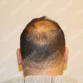 Before hair transplant