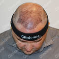 After hair transplant