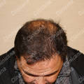 Result after hair transplant