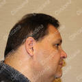 Result after hair transplant