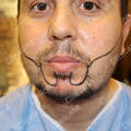 Preparing to beard transplant