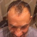 Before hair transplant