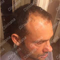 Before hair transplant