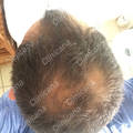 Before hair transplant