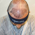 2 days after hair transplant