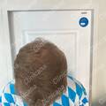Result after 7 months